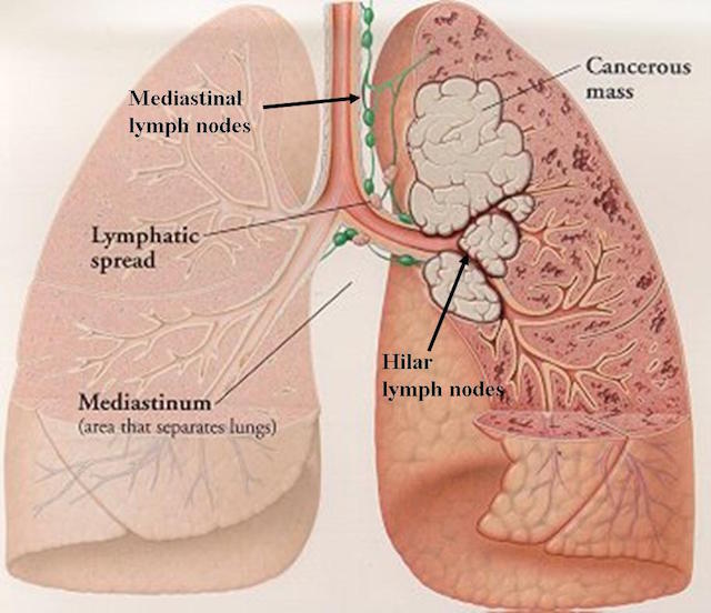 Lung Cancer A Common Malignant Disease